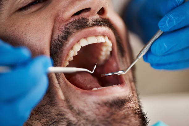 Best Walk-In Emergency Dental Services in Union City, CA