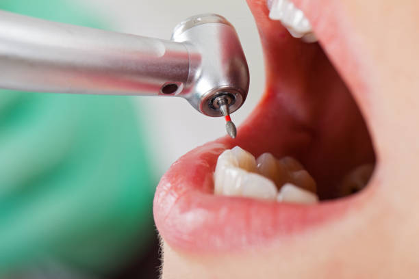 Best Emergency Root Canal Therapy in Union City, CA